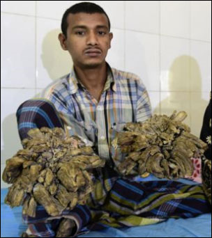 나무인간병을 앓고 있는 아불 바한다르(27세)