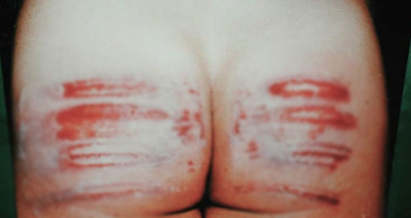 태형 직후 마이클 페이의 엉덩이 사진