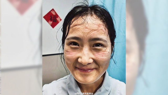 고글을 오랫동안 착용해 얼굴이 일그러진 중국 우한 의료진