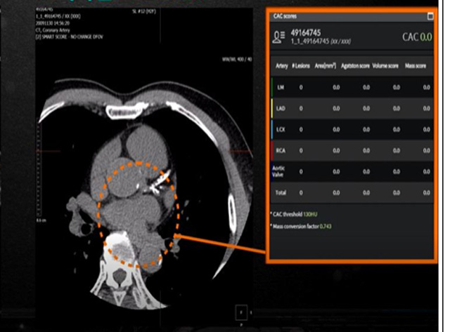 환자의 영상을 AI가 판독해 관상동맥 석회화 병변 위치(오른쪽 동그라미)를 찾아내고, 석회화 점수(왼쪽 네모)를 자동 산출하는 기능