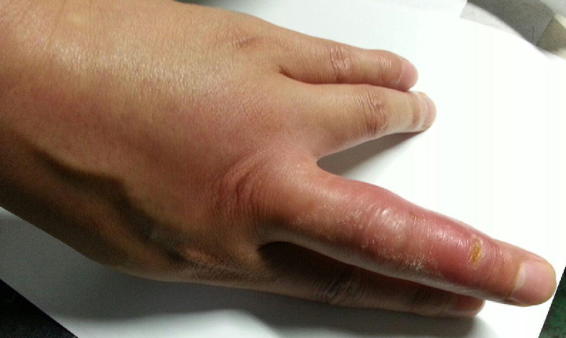 2015년 협재해수욕장에서 파란선문어에 물린 30대 남성의 손가락(사진=국립수산과학원)