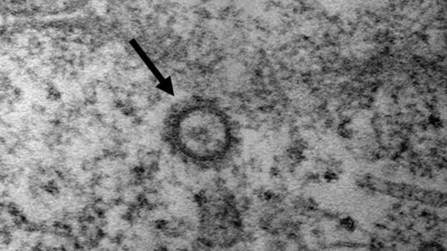코로나19 바이러스(SARS-CoV-2)의 전자현미경 사진