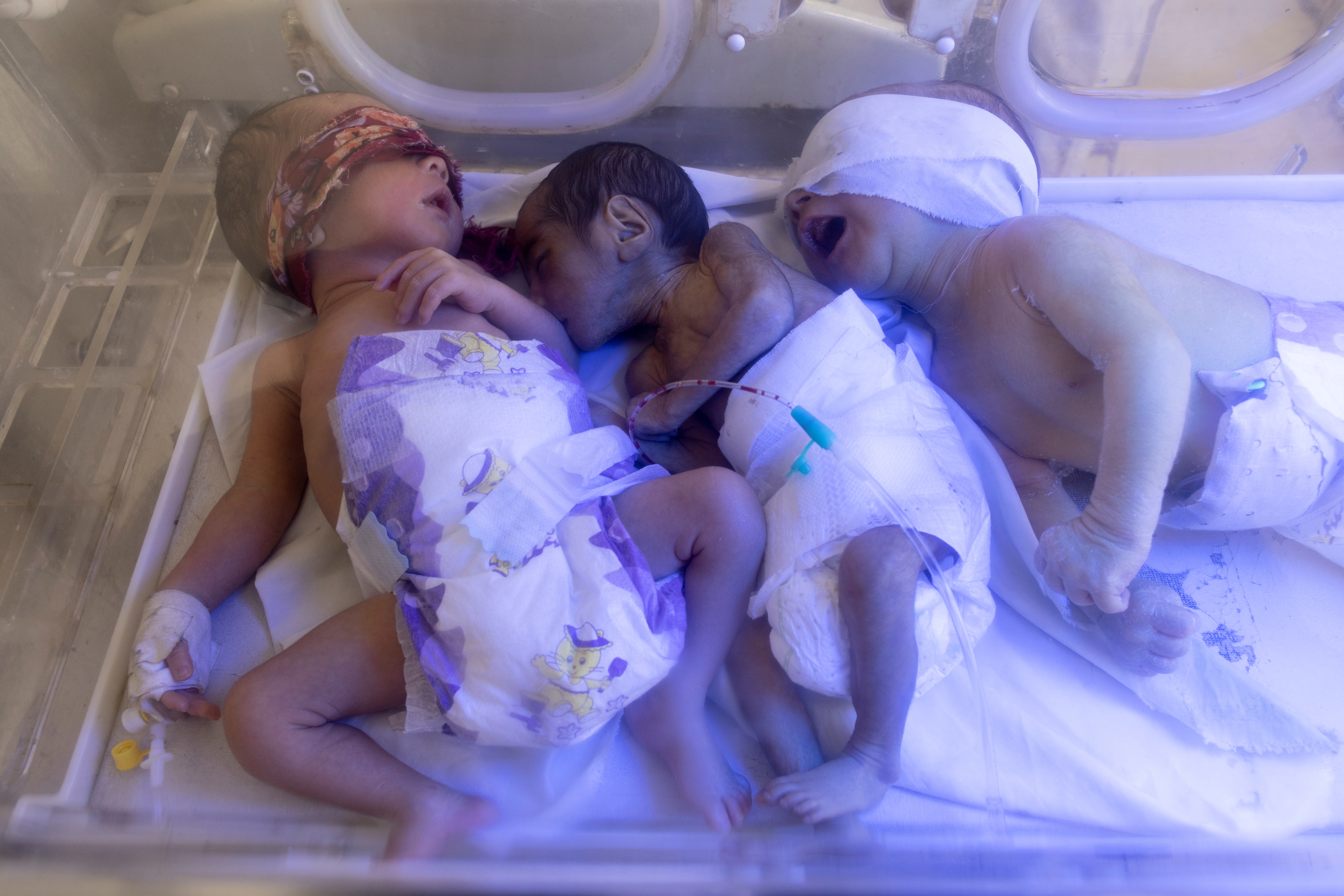 인큐베이터가 부족해 3명의 아기가 인큐베이터를 나눠쓰는 아프간 병원