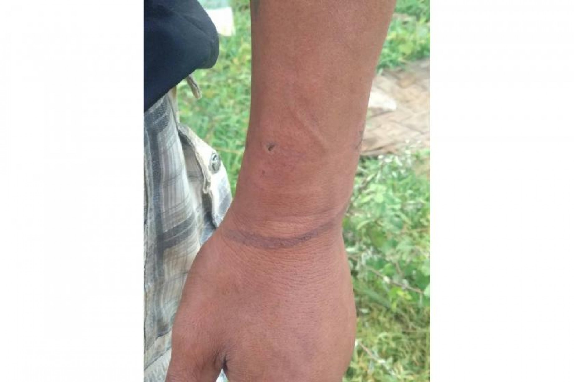샨주 모에비에서 탈출한 주민의 손목에 묶인 흔적이 남아있다. 사진 주민 SNS