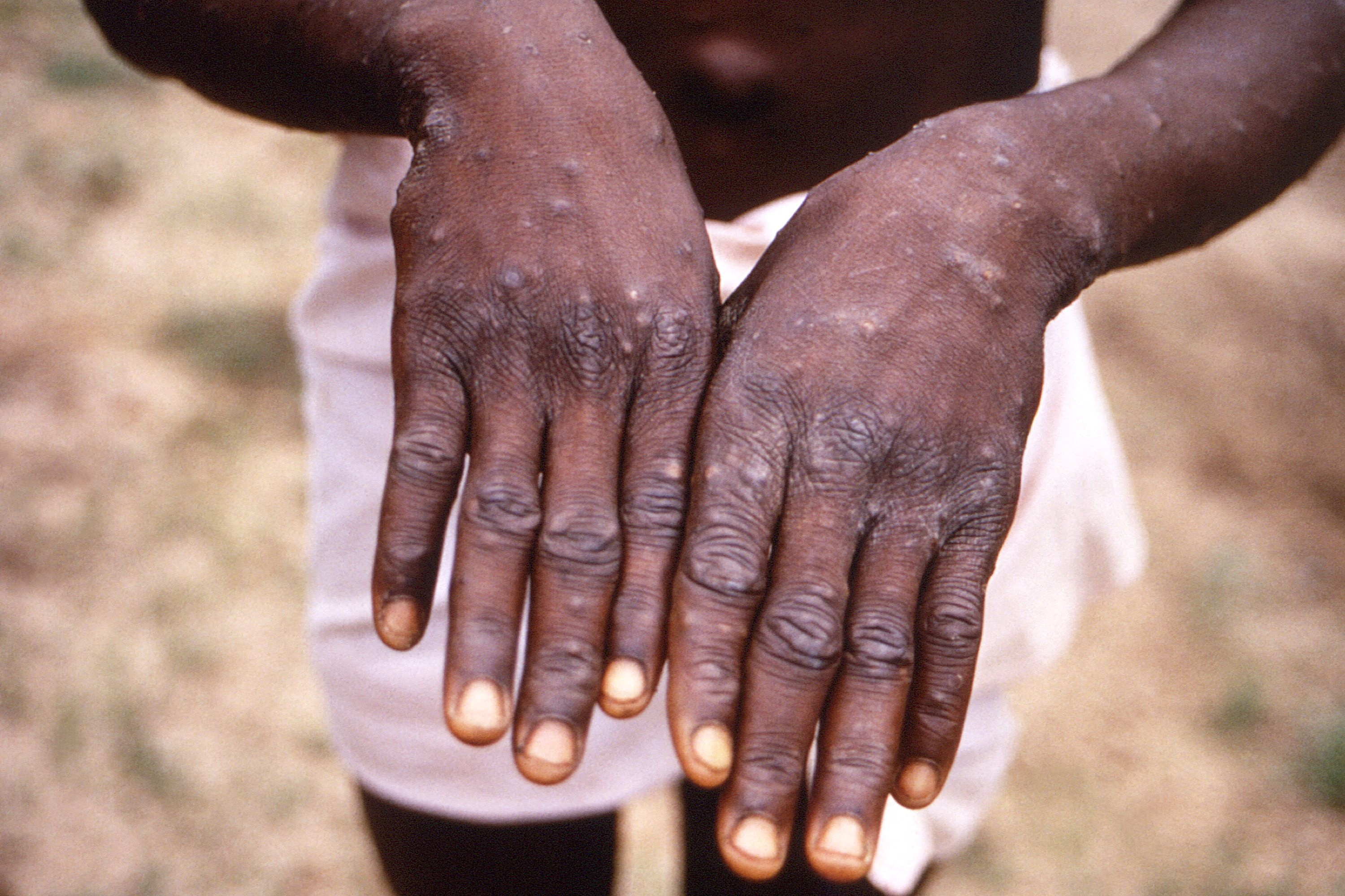 원숭이두창 보도에 계속 사용된 이 사진은 1996년-1997년 사이 콩고민주공화국(DRC)에서 발생한 원숭이두창 조사 중 촬영된 환자의 손이다.