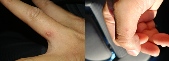 붉은불개미에 물린 뒤 증상을 보이는 김효중 군산대 교수의 손. (사진 출처=김효중 교수 제공)