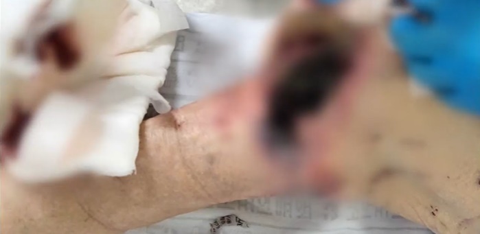 지난 9일 서귀포의료원 응급실에서 병원 간호사가 촬영한 강 씨 아버지 다리. 앙상하게 마른 다리의 무릎이 새까맣게 썩어가고 있다. 피와 진물이 나오고 악취가 난 것으로 전해졌다.