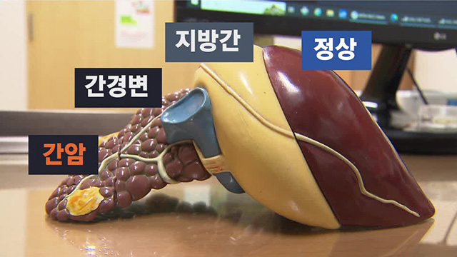 지방간은 술 때문? 그보다 더 큰 원인 있다!