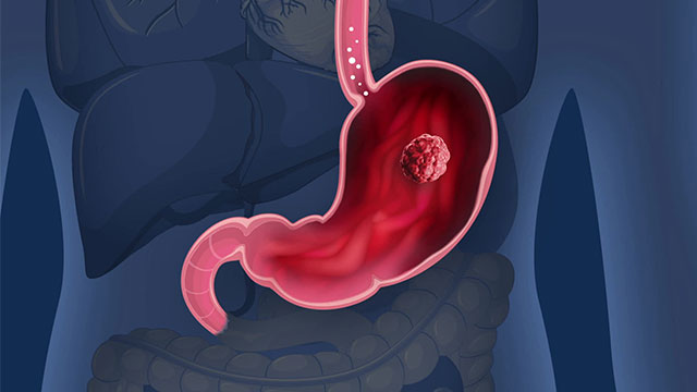 짠 음식이 위암 유발한다는데…무심코 먹어도 기준 <br>초과 기사 이미지