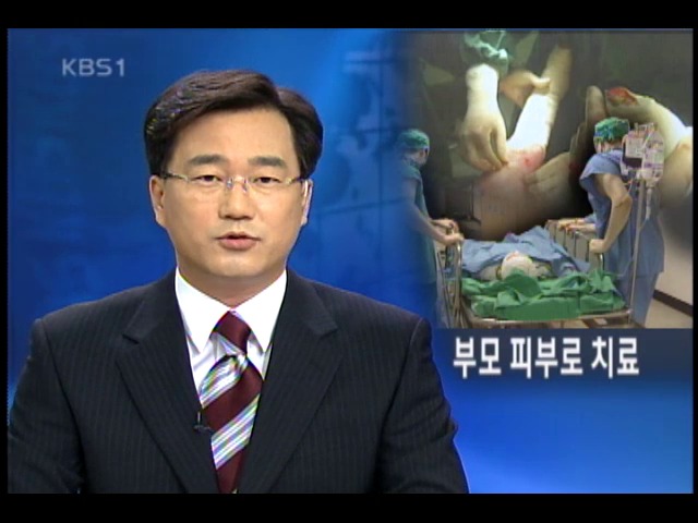 화상 환자, 부모 피부 이식 치료 