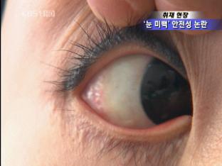 [취재현장] ‘눈미백 수술’ 안전성 논란