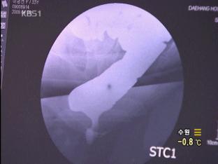 [건강하게 삽시다] 항문 질환 예방과 치료