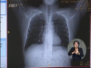 ‘결핵 환자’ 5년 새 60% 증가