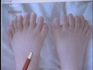 ‘손가락 15개·발가락 16개’ 소년 수술 성공
