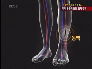 [건강뉴스] 다리 통증 절반, 동맥경화가 원인