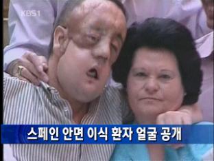 스페인 ‘안면 이식 환자’ 얼굴 공개