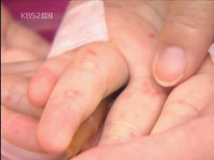 수족구병 올해 첫 어린이 사망
