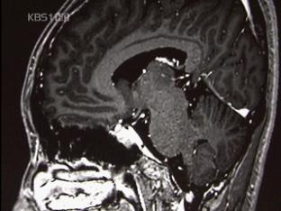 “뇌출혈 MRI 사진 대신 찍어드려요”