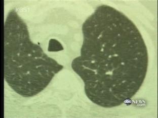 저용량 CT로 폐암 조기 발견 가능