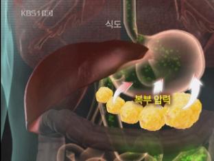 복부 내장 비만, ‘식도염’ 유발한다!