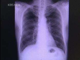 흉부 CT 검진, 폐암 사망률 20% 낮춰