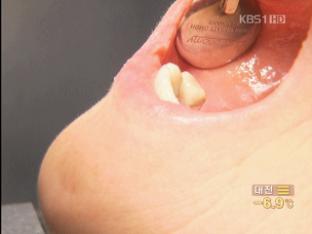 [우리몸 바루기] 골다공증 약, 턱뼈 괴사 위험