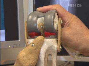 5년 새 무릎 인공관절수술 2배 증가