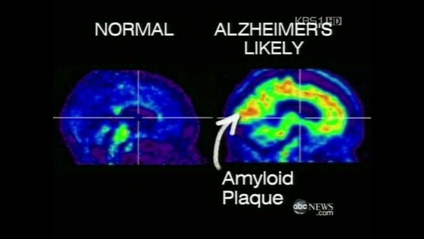 두뇌 스캔으로 알츠하이머 확진 가능