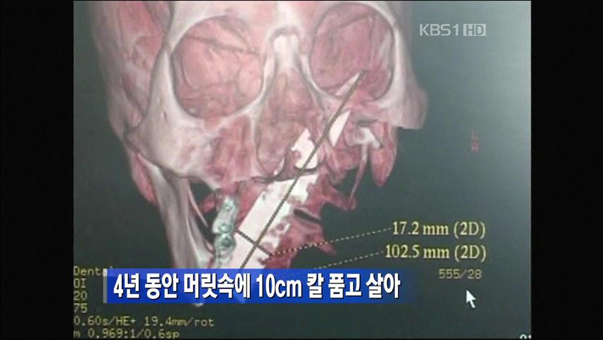 4년 동안 머릿속에 10㎝ 칼 품고 살아