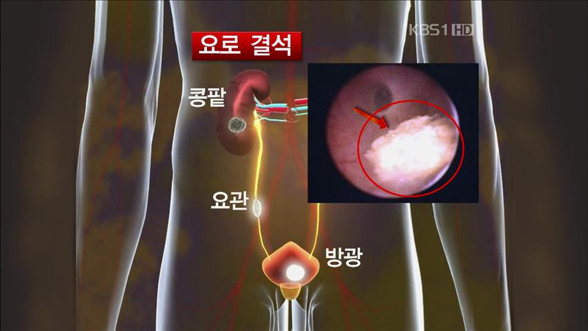 ‘요로결석 환자’ 증가…남성이 2배 많아