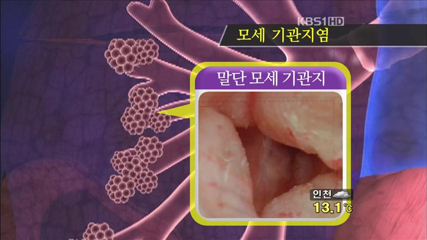 환절기 영유아, 모세기관지염 조심!