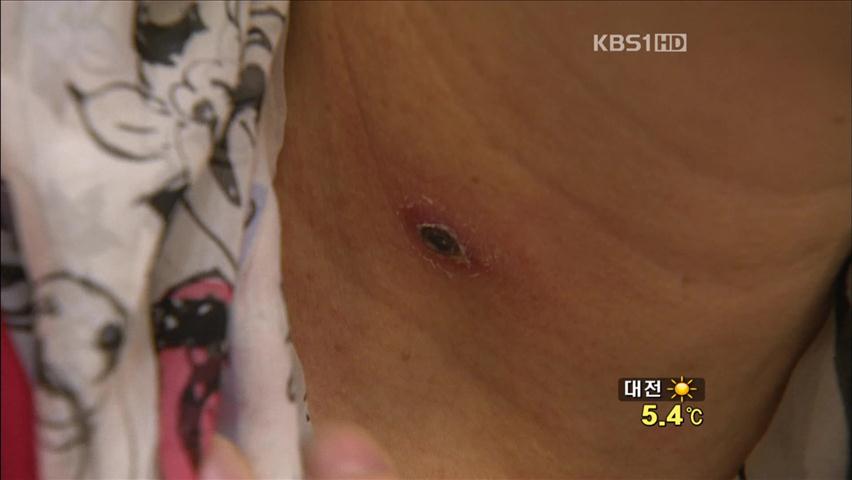 가을철 쯔쯔가무시병 비상!
