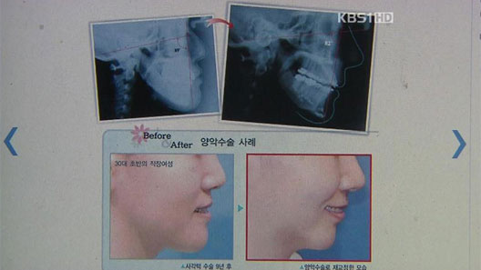 “양악수술 부작용 설명 안 해” 6천만 원 배상