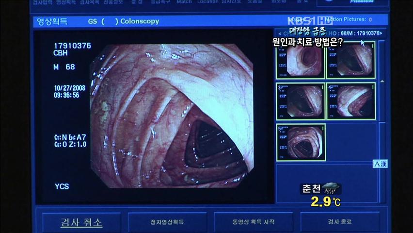 대장암 급증…원인과 치료 방법은?