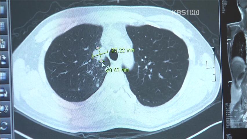 ‘비흡연자 폐암’ 이유 찾아…맞춤 치료 가능
