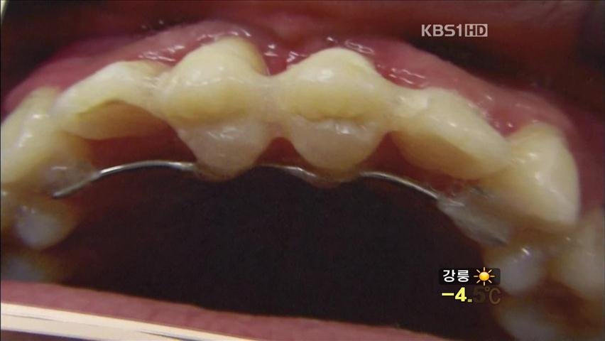 일본서 냉동 보관 ‘치아은행’ 인기