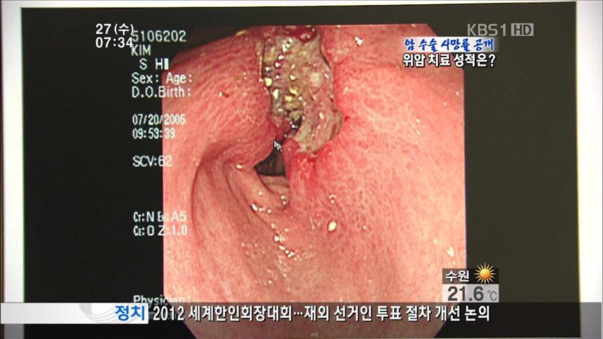 암 수술 사망률 공개…위암 치료 성적은?