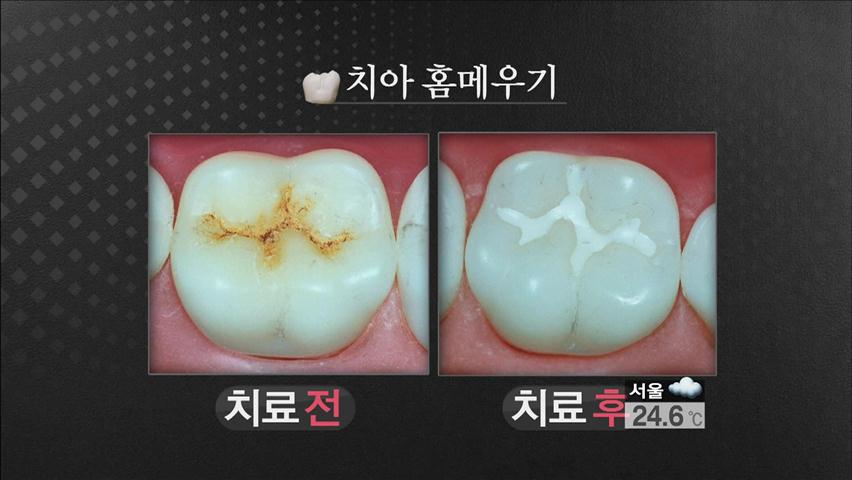 ‘치아 홈메우기’ 보험 적용 확대