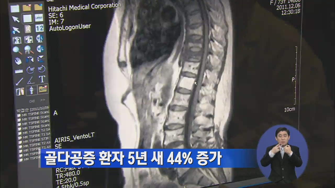 골다공증 환자 5년 새 44% 증가