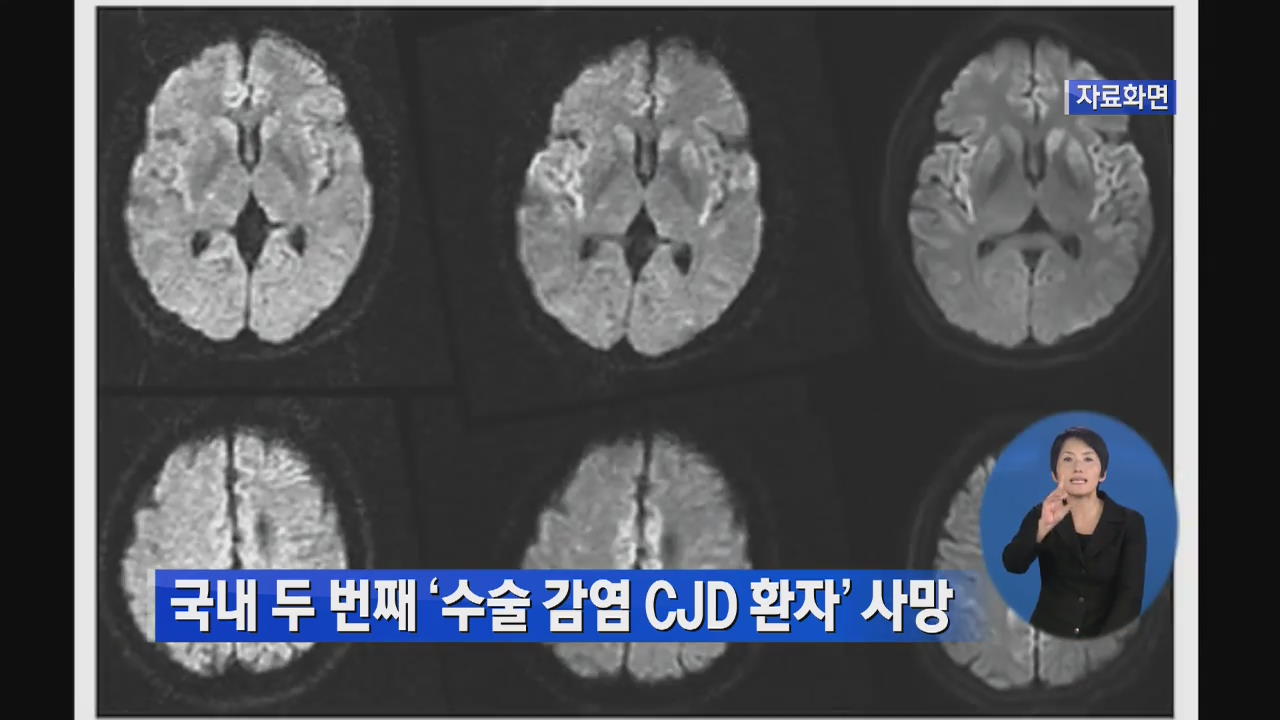 국내 두 번째 ‘수술 감염 CJD 환자’ 사망