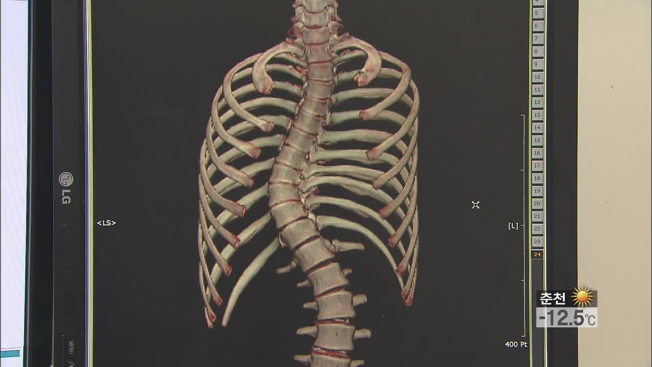 운동 부족으로 청소년 척추 측만증 급증