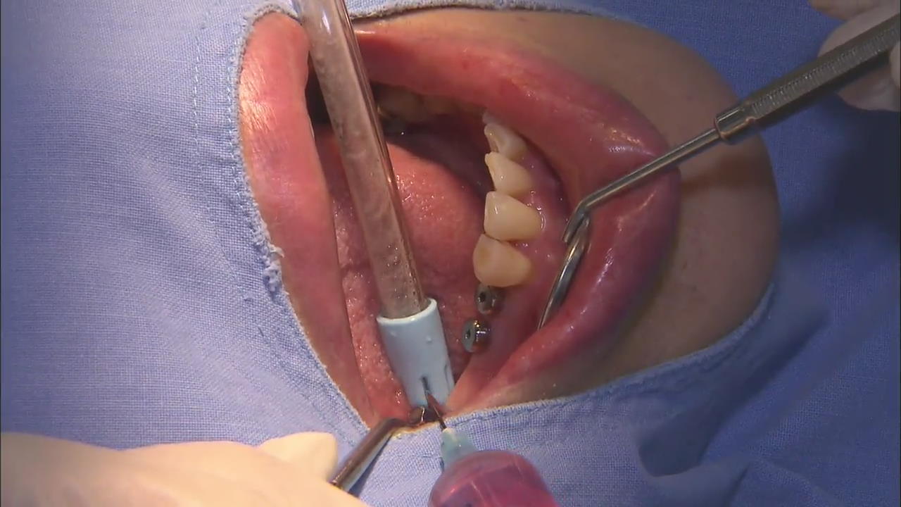 미세수술로 염증 치료…자연 치아 살린다