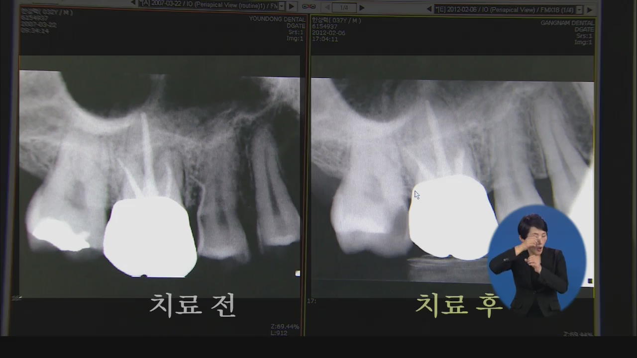 미세수술로 염증 치료…자연 치아 살린다