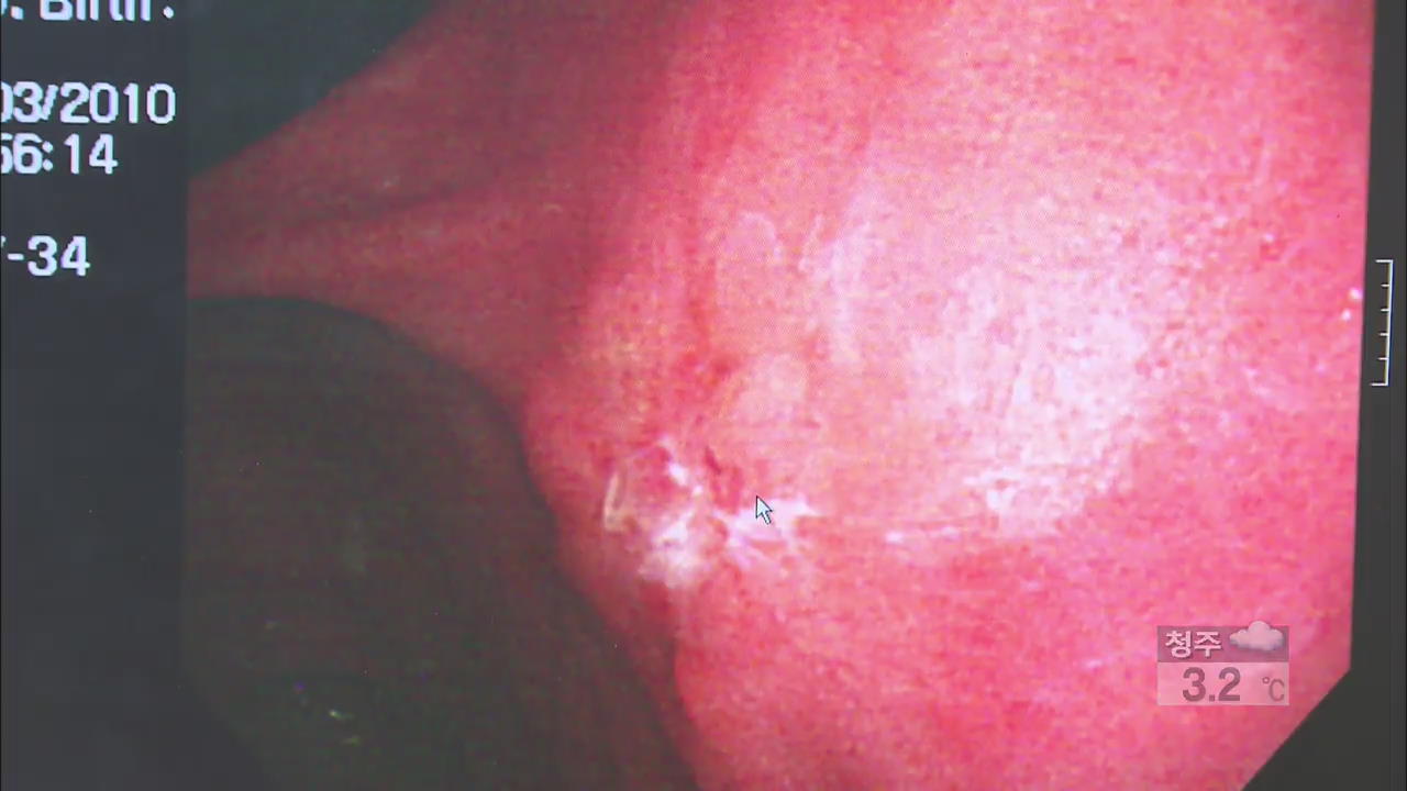 위암 완치율 높다고 방심했단 대장암 위험