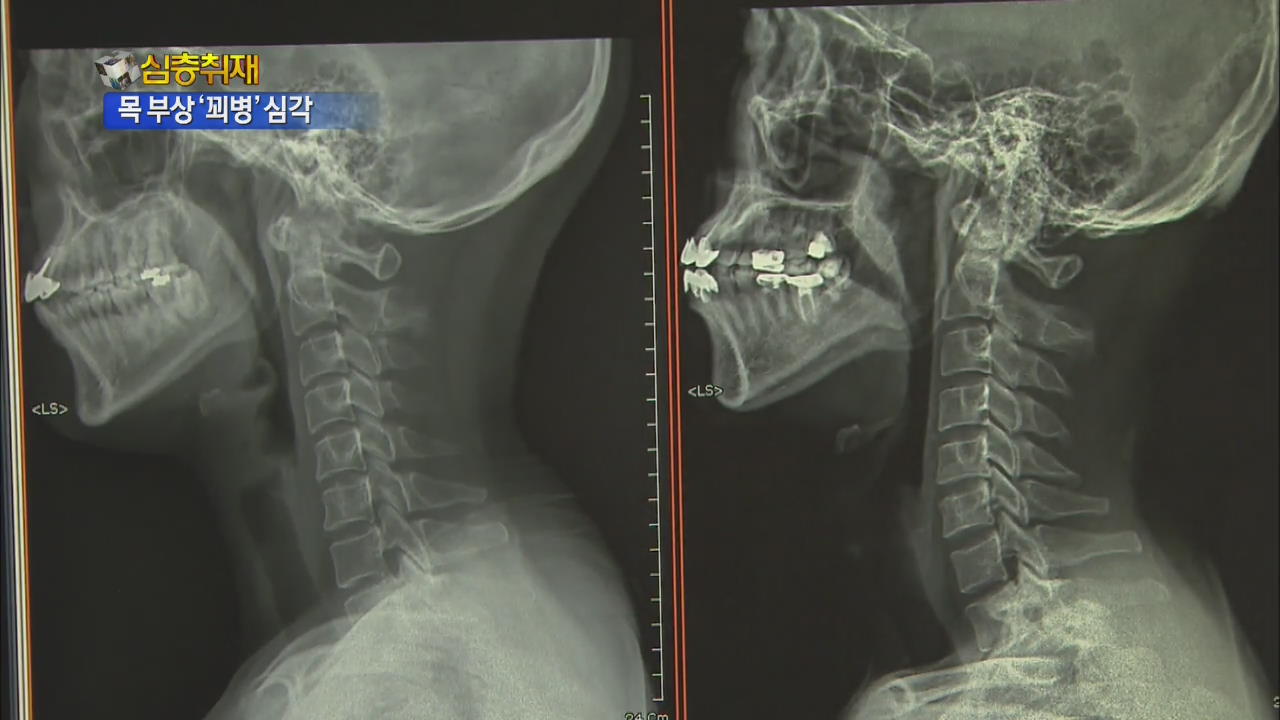 [심층취재] 추돌 사고 목 부상 절반 가량 ‘꾀병’