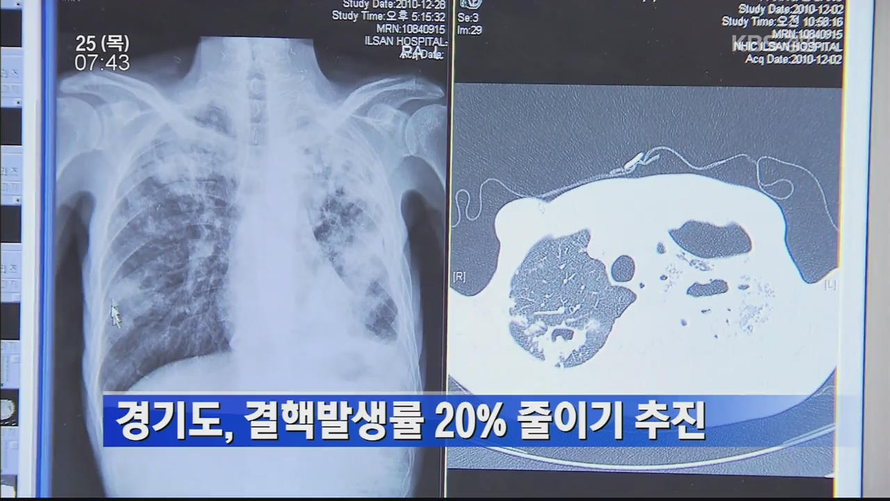 경기도, 결핵발생률 20% 줄이기 추진