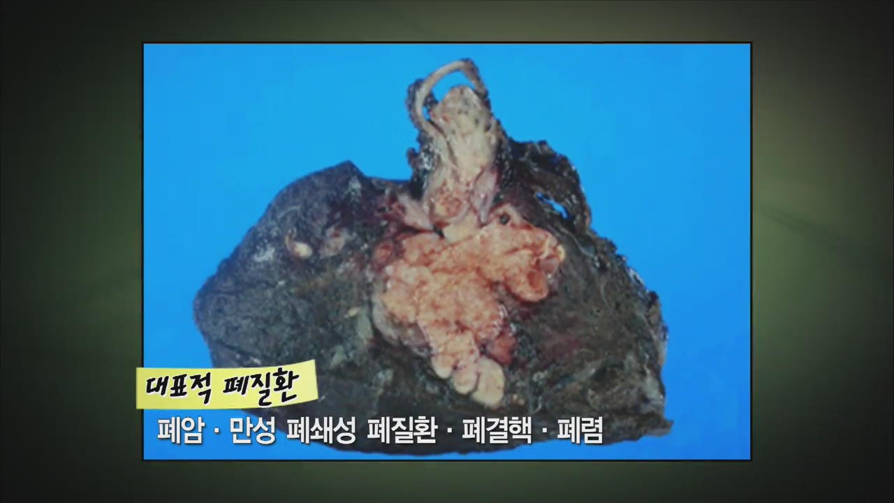 [알약톡톡] 숨통을 조이는 폐질환