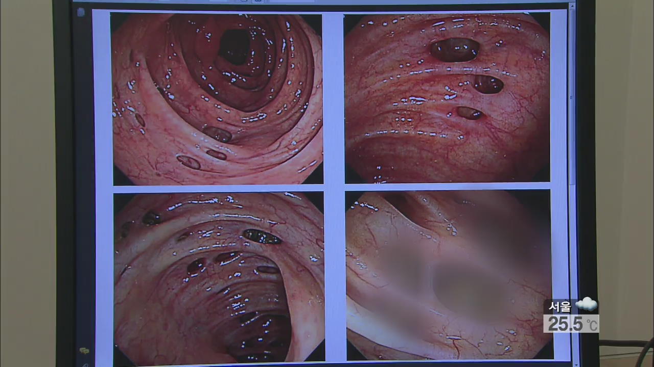 장 변형되는 ‘게실병’ 급증…식생활 서구화 탓