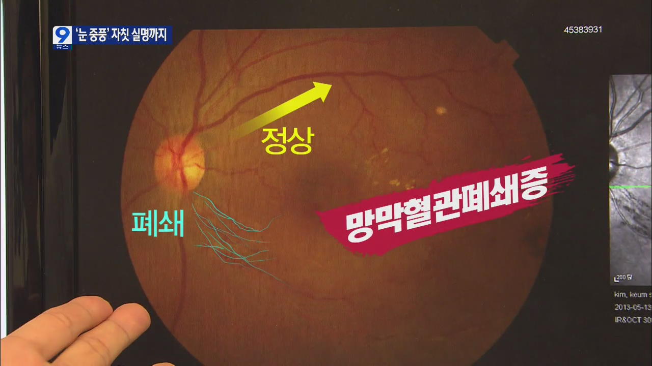 눈 중풍 ‘망막혈관 폐쇄증’, 5년새 42% 증가