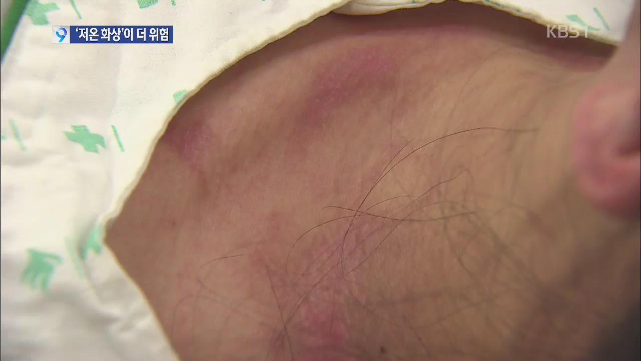 [앵커&리포트] 전기장판·핫팩 사용하면 화상 위험?